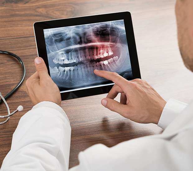 Emerson Types of Dental Root Fractures